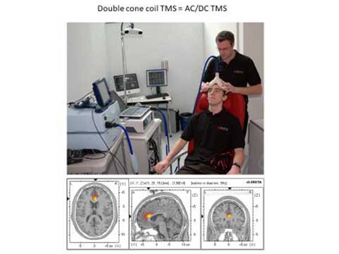 Double Cone Coil TMS